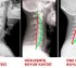 Boyun Düzleşmesi ve Modern Tedavi Yöntemleri
