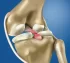 Menisküs Sakatlıklarında Görülebilecek Muhtemel Sorunlar