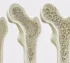 Osteoporoz Kadınlarda Daha Mı Sık Görülür?
