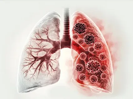 Amfizem ve Fizik Tedavi