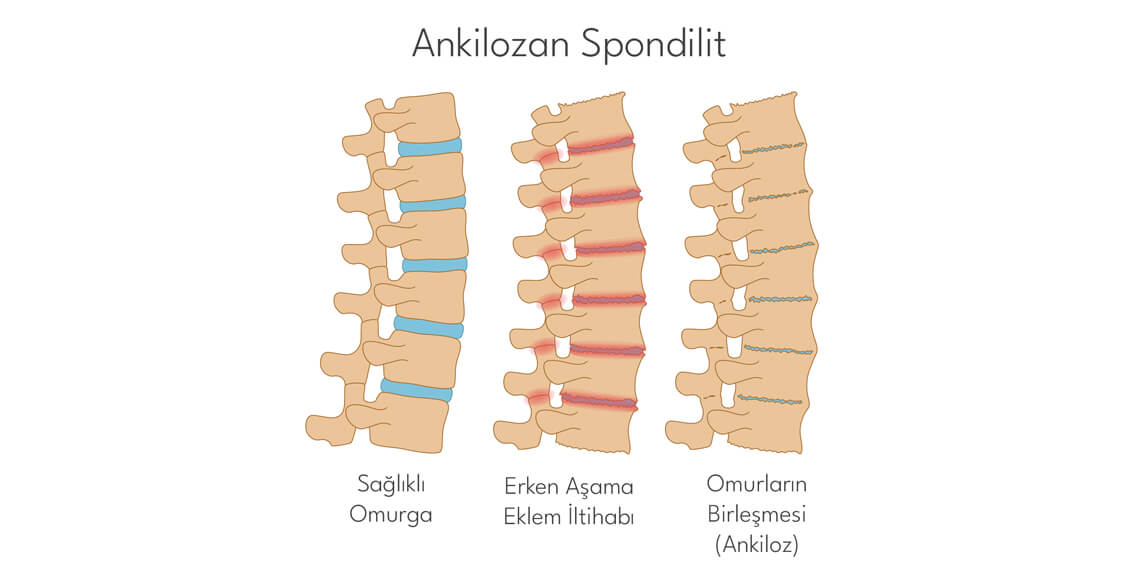 Ankilozan Spondilit Hastalığının Belirtileri ve Tedavisi