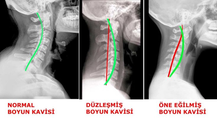 Boyun Düzleşmesi ve Modern Tedavi Yöntemleri