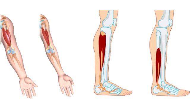 Çocuklarda DMD Hastalığında Belirtiler ve Tedavi Süreci