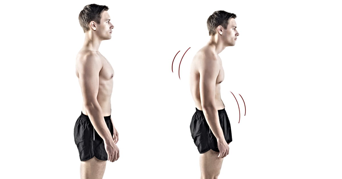 Duruş Bozukluklarının Tedavisinde Egzersiz ve Biyomekanik Değerlendirme