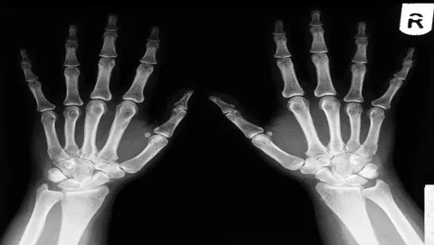 El Bileği Kırıklarından Sonra Robotik Rehabilitasyon Uygulanır mı?