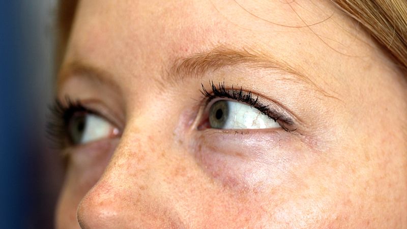 Herediter Ataksi Hastalarında Fizyoterapi Süreci