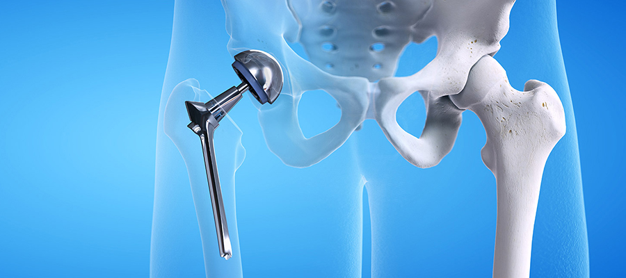 Kalça Protezi Sonrası Hızlı İyileşme İçin Yapılması Gerekenler