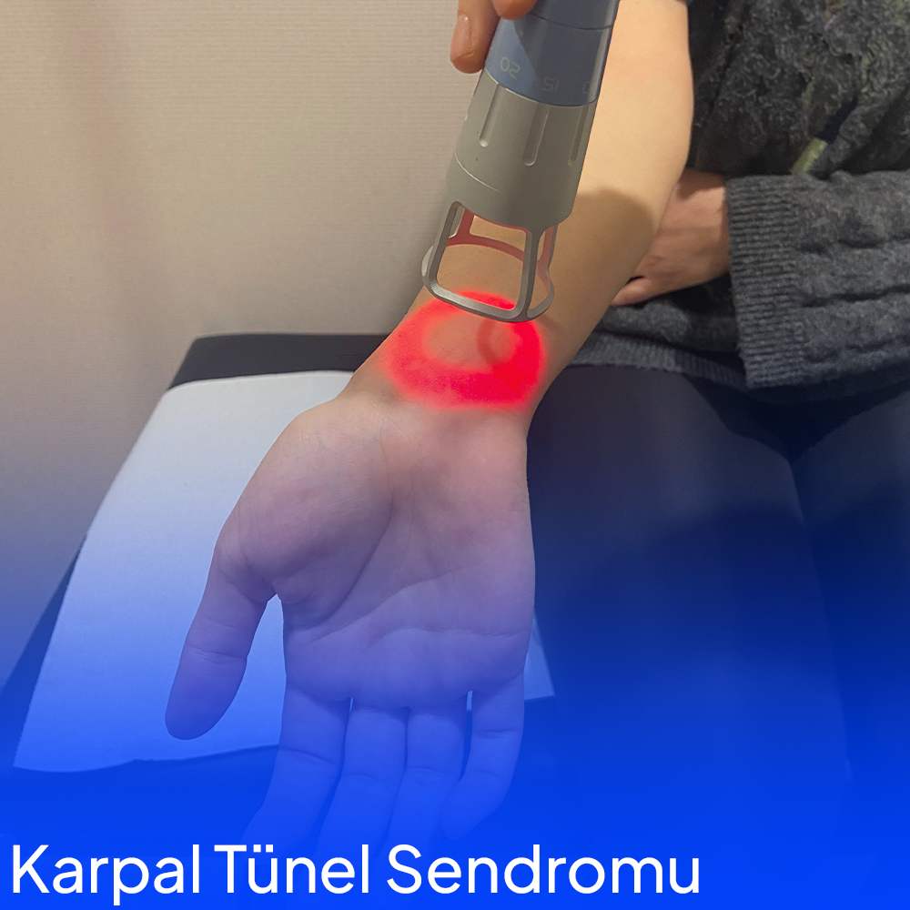 Karpal Tünel Sendromu Nedir ?