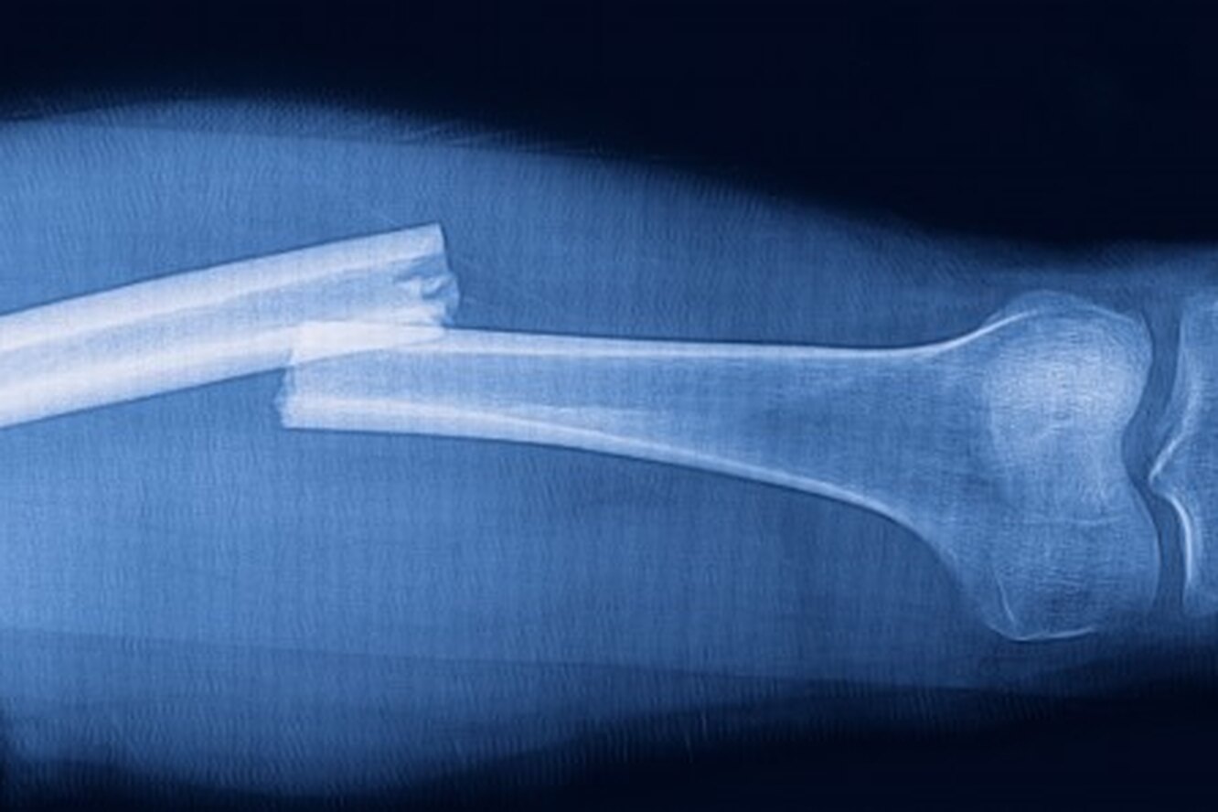 Kırık Sonrası Fizyoterapi ve Rehabilitasyon