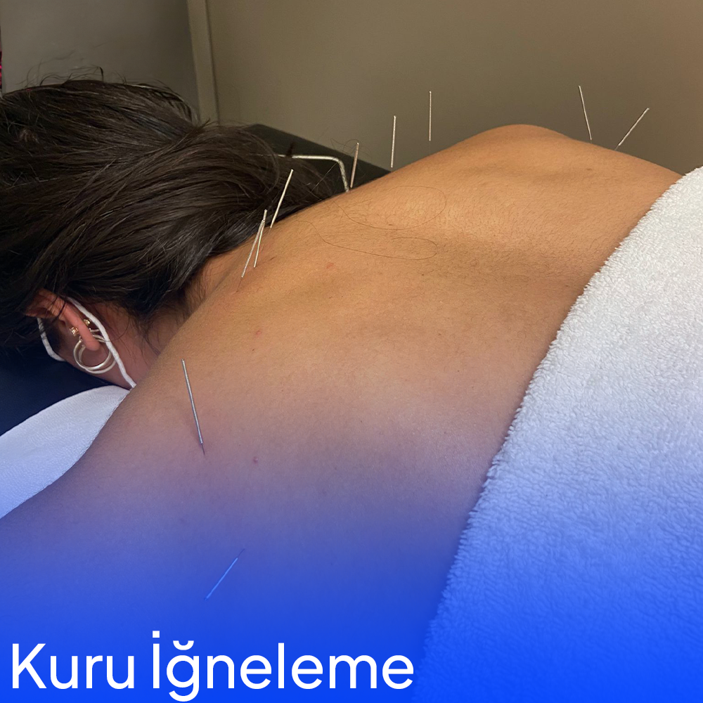 What is Dry Needling Treatment?