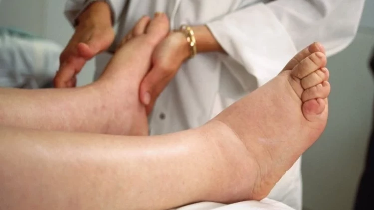 Lenfödem İyileşir mi? Nasıl Tedavi Edilir?