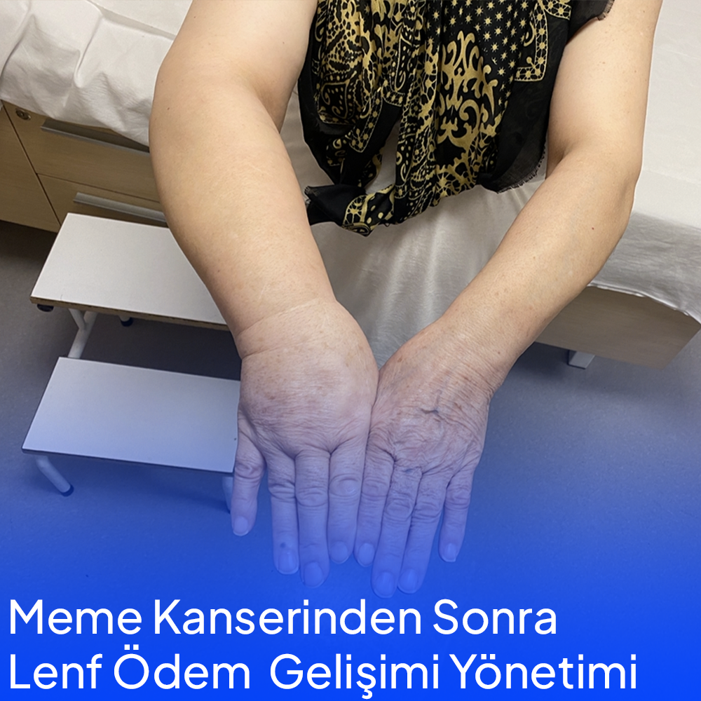 Development and Management of Lymphedema After Breast Cancer