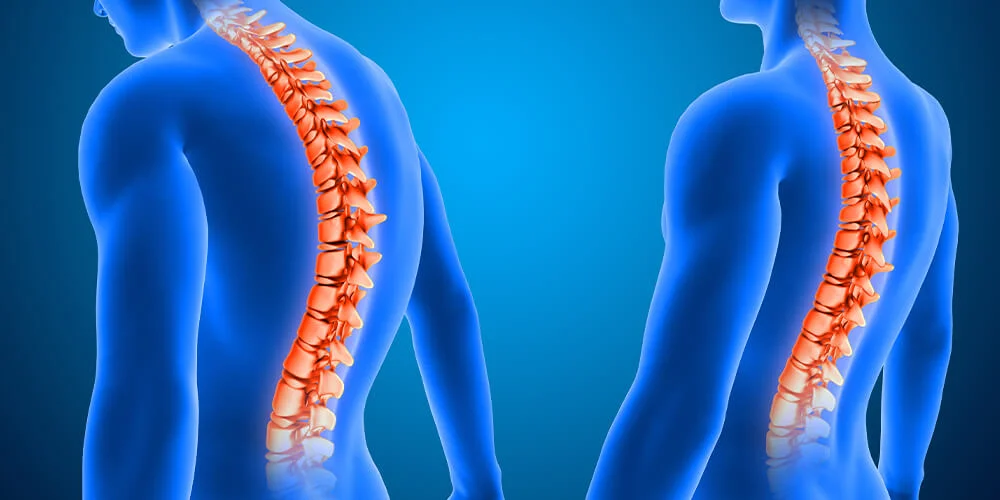 Omurga Deformitelerinde Fizik Tedavi