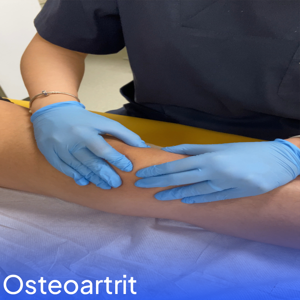 Osteoartrit Tedavisinde Fizik Tedavi