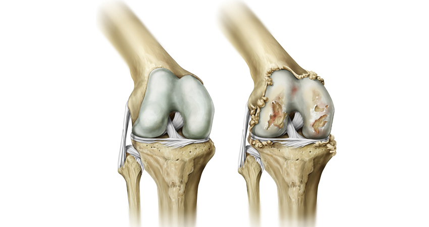 Osteoartrit Ve Fizyoterapi 