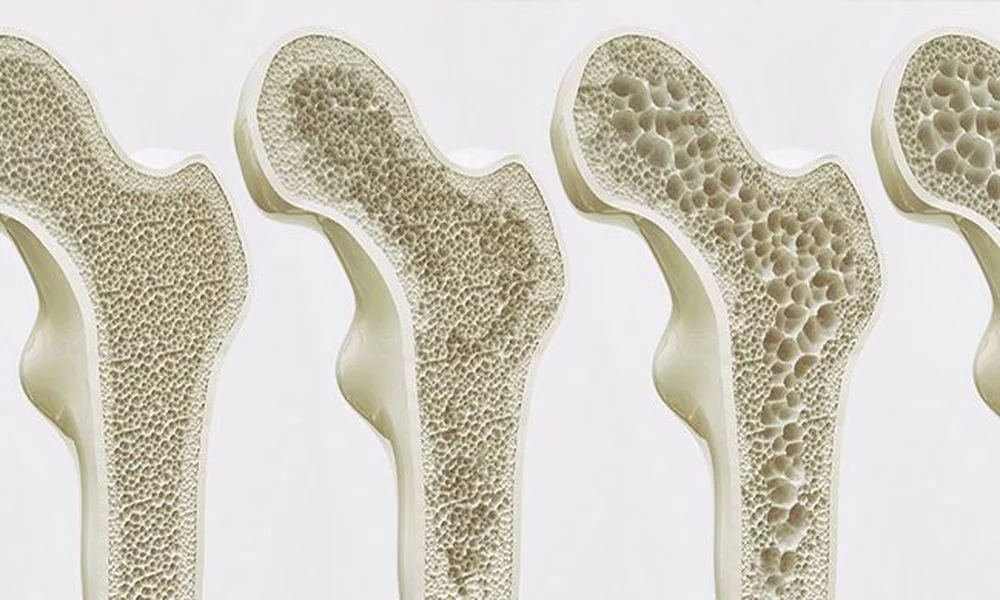 Osteoporoz Kadınlarda Daha Mı Sık Görülür?
