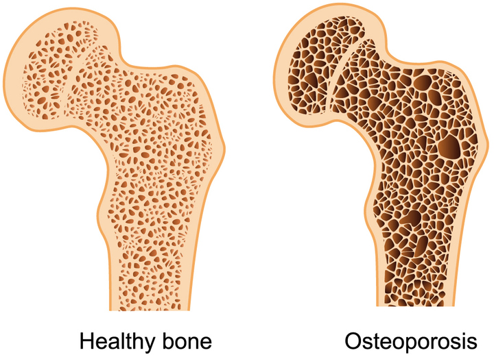 Osteoporoz (Kemik Erimesi): Risk Faktörleri ve Korunma Yolları