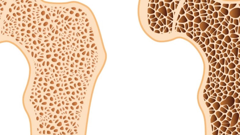 Osteoporozda Egzersiz Yaklaşımları ve Düşme Riskinin Azaltılması