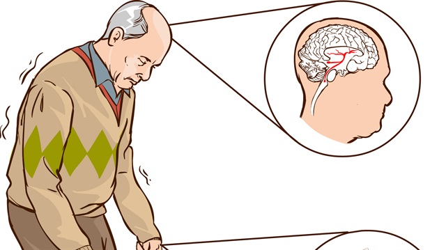 Parkinson Hastalarında Robotik Rehabilitasyon