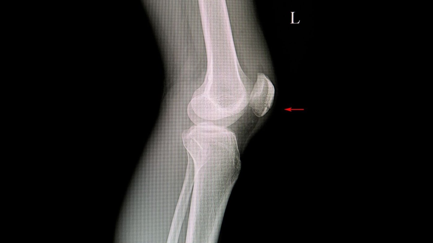 Patella Kırıklarından Sonra Robotik Rehabilitasyon Uygulanır mı?