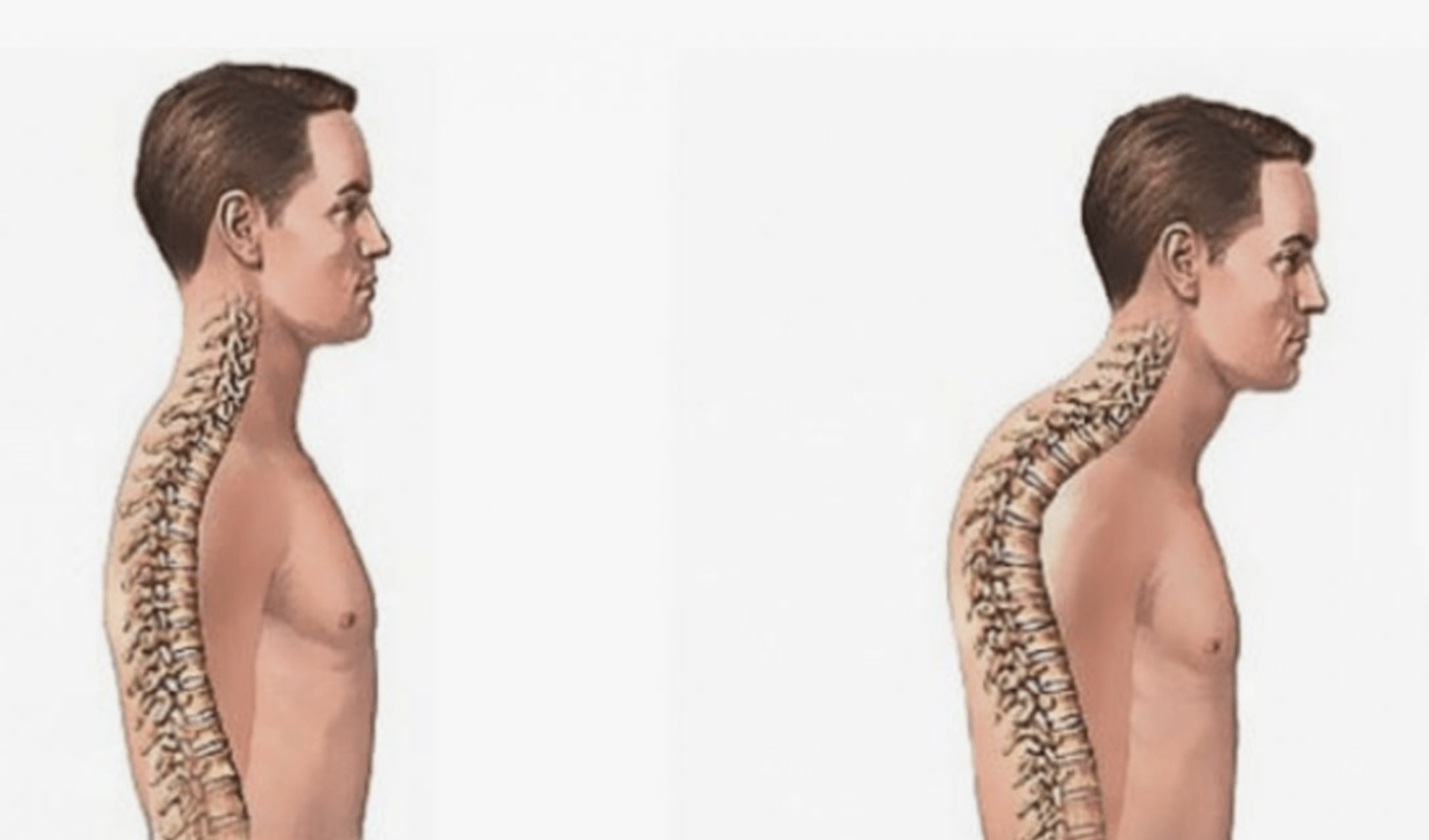 Postür Bozukluğu ve Kifozda Fizik Tedavi ile Düzeltme Programları