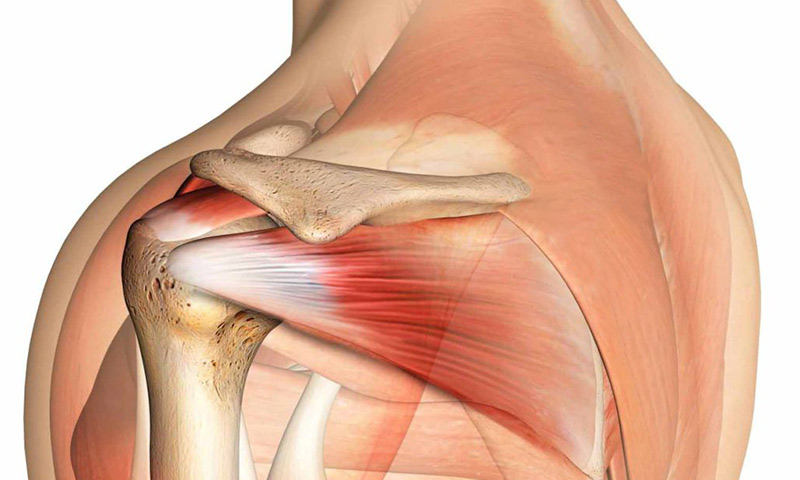 Rotator Manşet Yırtıkları: Fizyoterapi ve Rehabilitasyonun Rolü