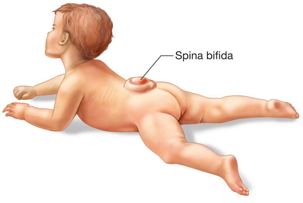 Spina Bifida ile Yaşamak: Günlük Hayatta Karşılaşılan Zorluklar ve Çözümler