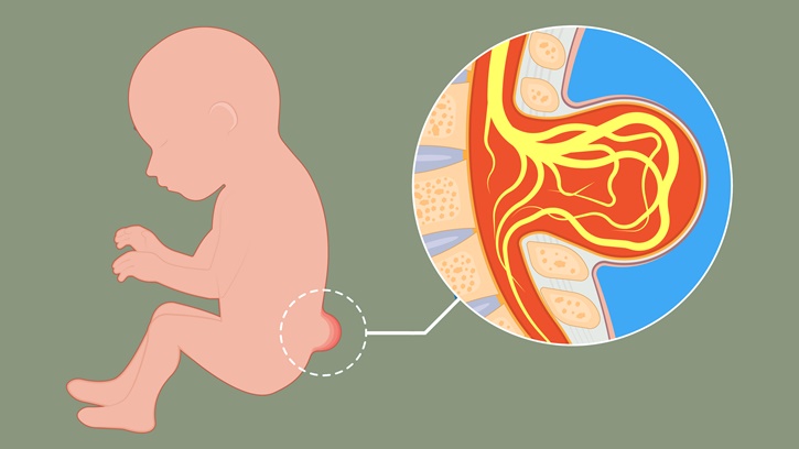 Spina Bifida Nedir? Belirtileri ve Tedavi Süreci Nasıl İşler?