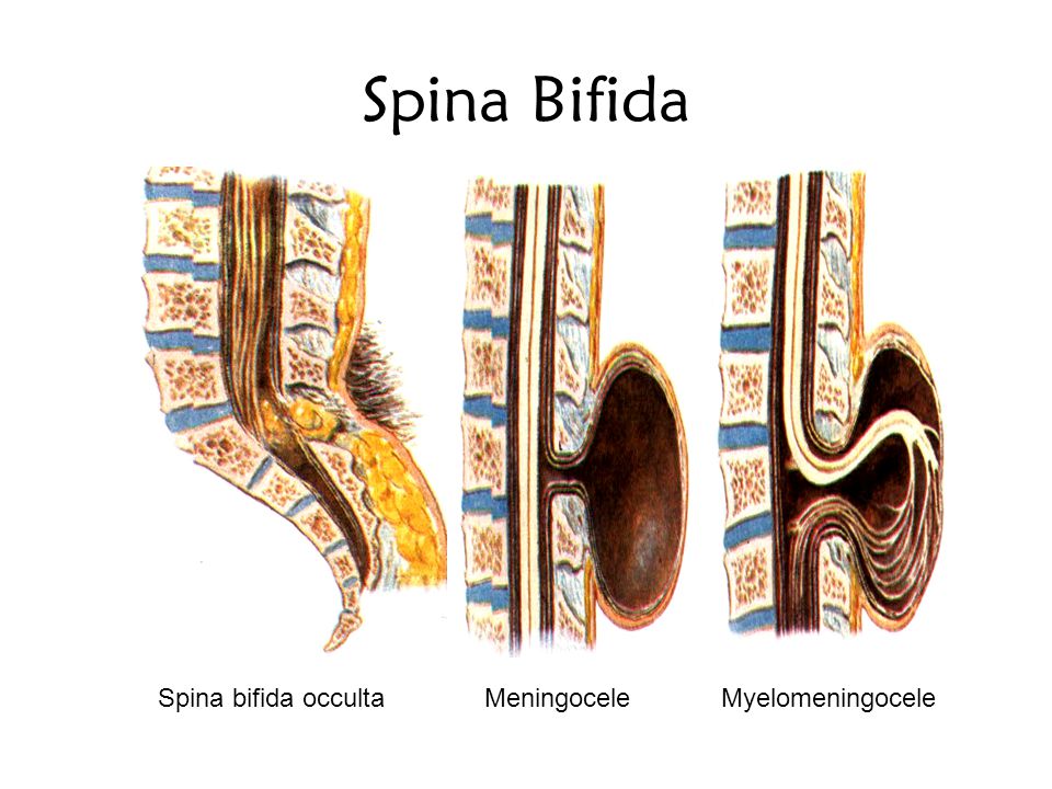 Spina Bifida ve Fizyoterapi’de Egzersiz