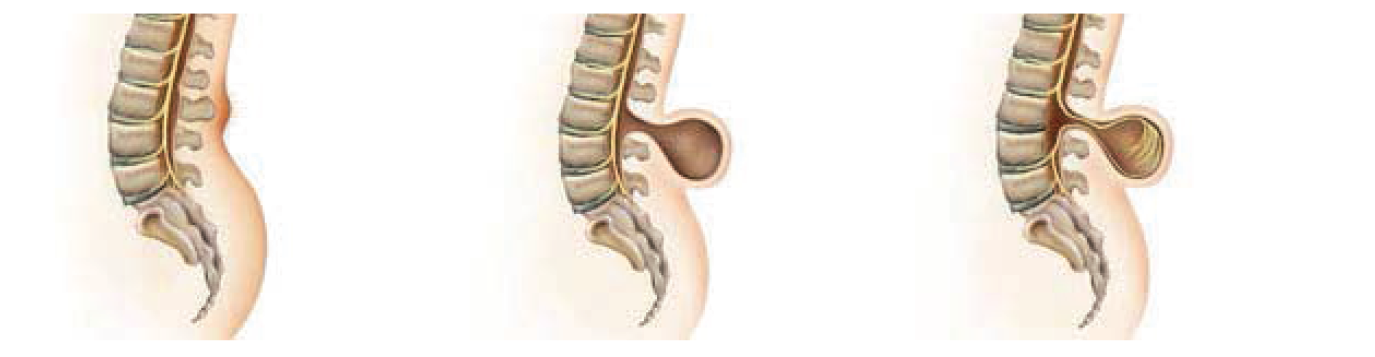 Spina Bifidada Robotik Rehabilitasyonun Önemi