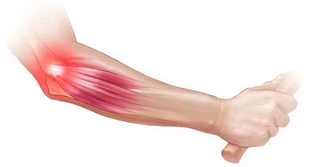 Tenisçi Dirseği: Fizyoterapi ve Rehabilitasyonun Rolü