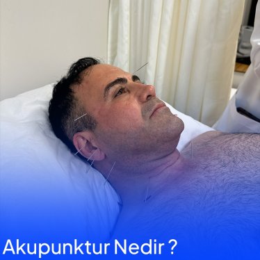 Akupunktur Nedir ? Nasıl Uygulanır ?
