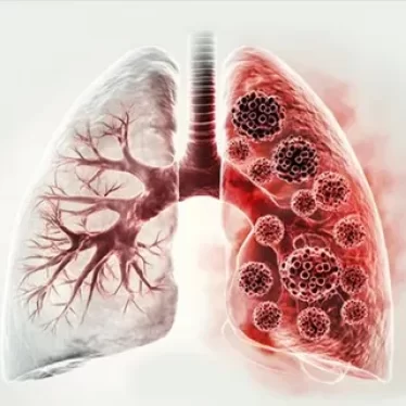 Amfizem ve Fizik Tedavi