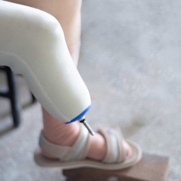 Amputasyon Sonrası Rehabilitasyon Süreci Nasıl İşler ?