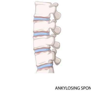 Ankilozan Spondilit: Belirtileri ve Tedavi Yöntemleri