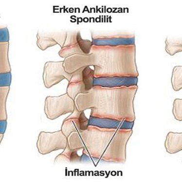 Ankilozan Spondilit Hastalarında Ergoterapi Teknikleri