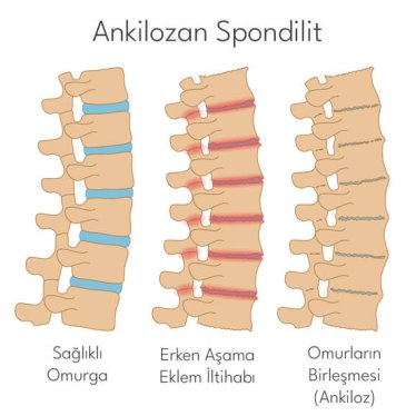 Ankilozan Spondilit Hastalığının Belirtileri ve Tedavisi