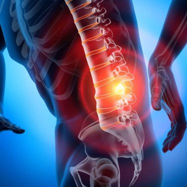 Bel Fıtığı : Fizyoterapi ve Rehabilitasyonun Rolü