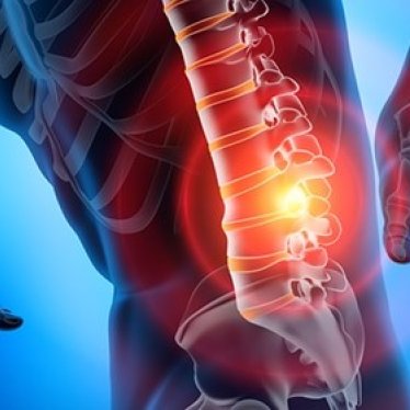 Bel Fıtığında Fizik Tedavi