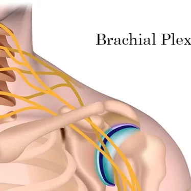 Brakial Pleksus ve Robotik Rehabilitasyon