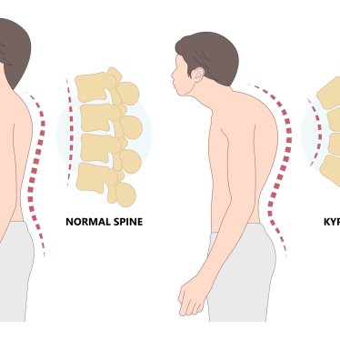 Çocuklarda Duruş Bozukluklarının Düzeltilmesinde Fizyoterapinin Rolü