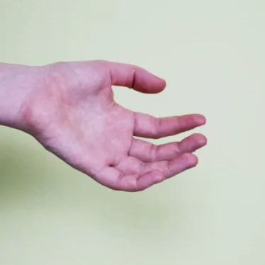 Distoni Fizik Tedavi ve Rehabilitasyon ile Tedavi Edilebilir mi?