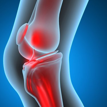 Diz Kireçlenmesi Olanlar İçin En Etkili Fizik Tedavi Yöntemleri