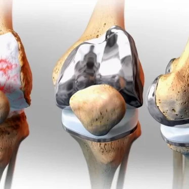 Diz Protezi Nedir? Tedaviler ve Amacı Nelerdir?