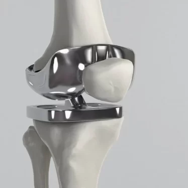 Diz Protezi Sonrası Hareket Özgürlüğünü Geri Kazanmak Mümkün mü?