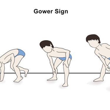 DMD Hastalarında Fizyoterapi Etkili Midir?