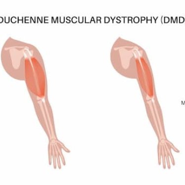 DMD’li Çocuklarda Zorluklar ve Rehabilitasyon