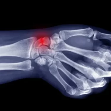 El Bileği Kırığı Sonrası Fizik Tedavi Süreci