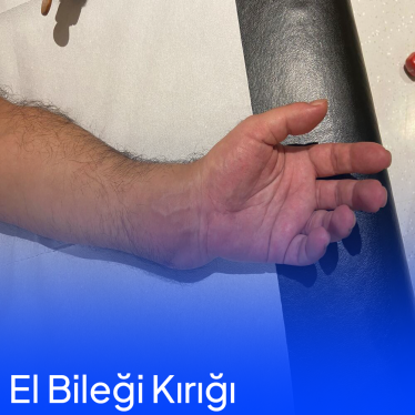 Elde Bilek Kırığı Tedavisi