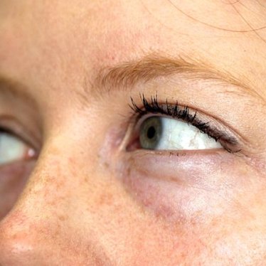 Herediter Ataksi Hastalarında Fizyoterapi Süreci